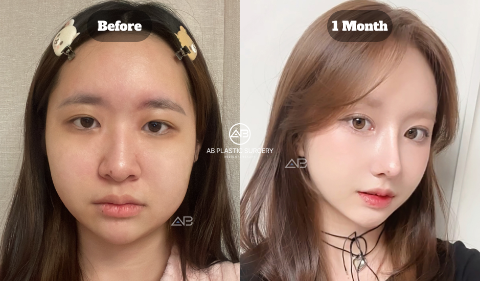 One Month Before And After Results Of Korean Eye Plastic Surgery With Double Eyelid Incision And Eyelid Correction Showing Natural Eye Shape Improvement