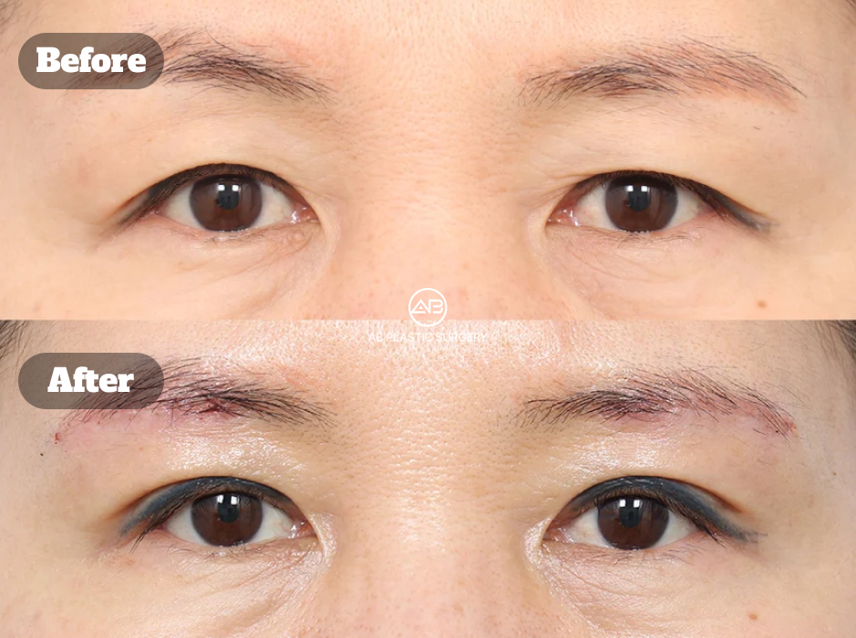 Before and After Ptosis Correction Combined With Upper Eyelid Lifting and Brow Lift Showing Improved Eyelid Elevation During Early Recovery