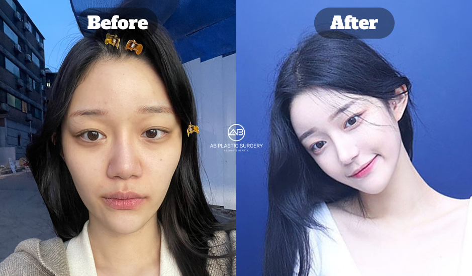 Before and After Results of Nose Revision and Zygoma Reduction Surgery at Korean Plastic Surgery Clinic Showing Facial Contour Improvement