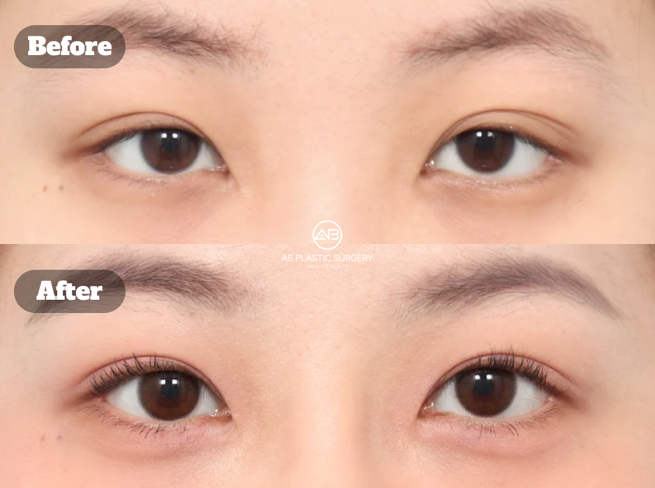 Before And After Results Of Korean Eye Plastic Surgery With Non Incision Ptosis Correction And Medial Epicanthoplasty Improving Eye Openness And Inner Eye Line