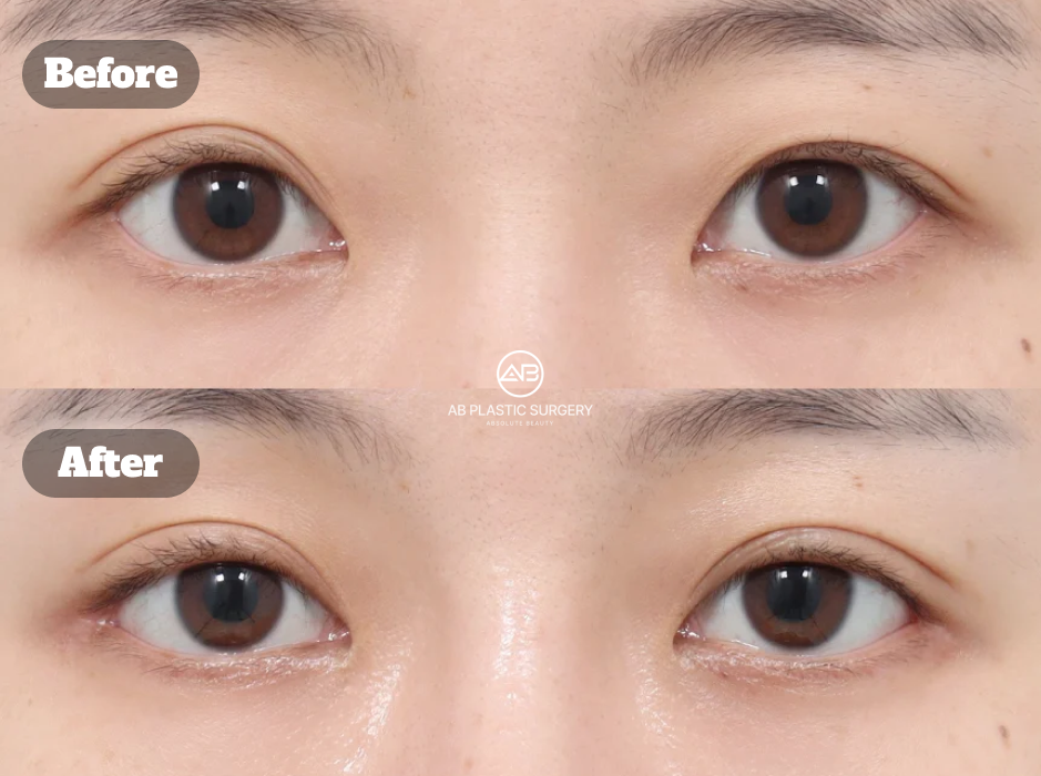 Before And After Results Of Korean Eye Plastic Surgery With Non Incision Ptosis Correction Lateral Canthoplasty Lower Canthoplasty And Endotine Brow Lift Enhancing Eye Width And Lift