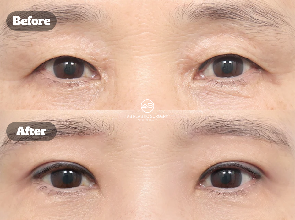 Before and After Ptosis Correction With Upper Eyelid Lifting and Brow Lift Reducing Eyelid Sagging and Improving Eye Contour