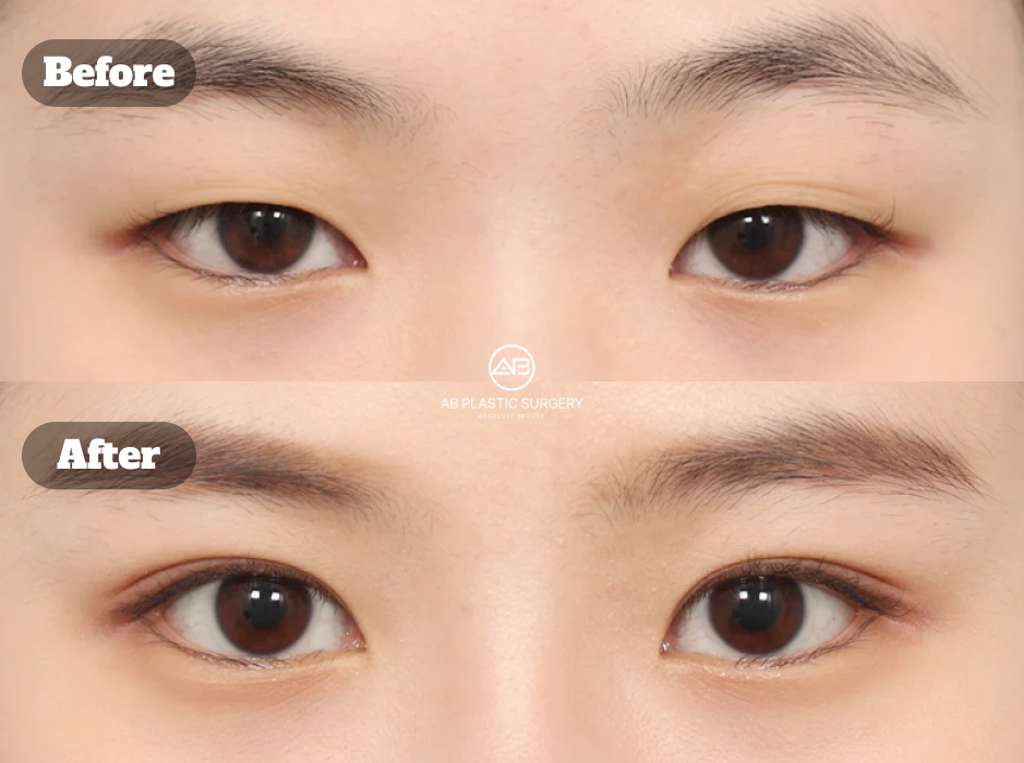 Before And After Results Of Korean Eye Plastic Surgery With Non Incision Ptosis Correction And Upper Eyelid Fat Removal Creating Clearer And More Defined Eye Shape