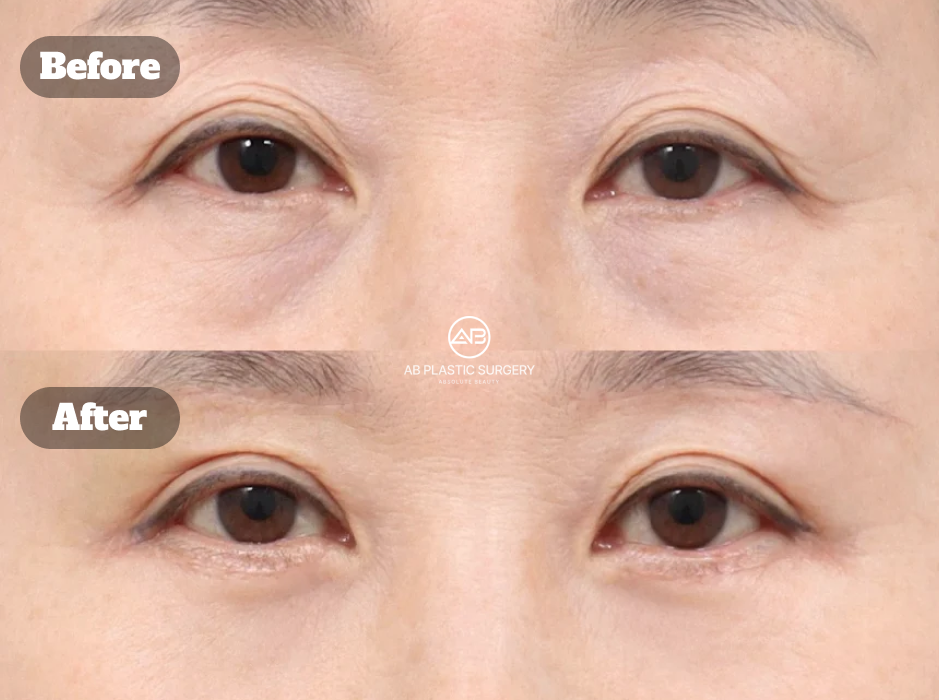 Before and After Ptosis Correction Revision With Upper Eyelid Lift, Brow Lift, and Lower Eyelid Surgery Improving Tired Looking Eyes and Natural Eye Appearance