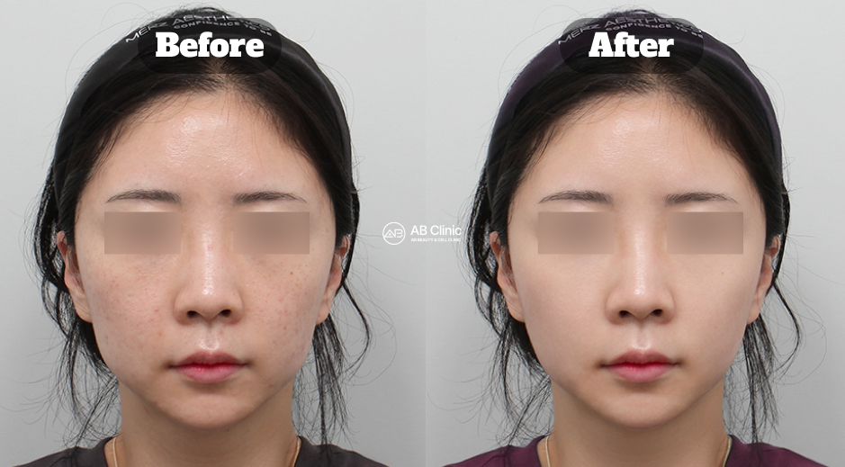 Before and After Skin Treatment Using Potenza and Laser Therapy at Korean Clinic Showing Improved Skin Texture and Reduced Acne Marks