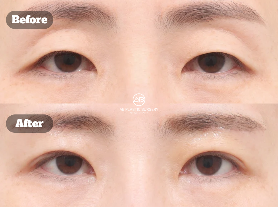 Before and After Ptosis Correction With Upper Eyelid Lifting and Brow Lift Enhancing Eye Clarity and Refined Eyelid Contour