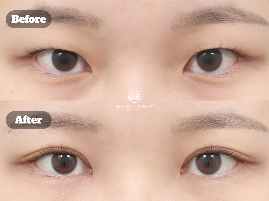 Before And After Results Of Korean Eye Plastic Surgery With Incision Ptosis Correction And Epicanthoplasty Improving Eye Definition And Inner Eye Line