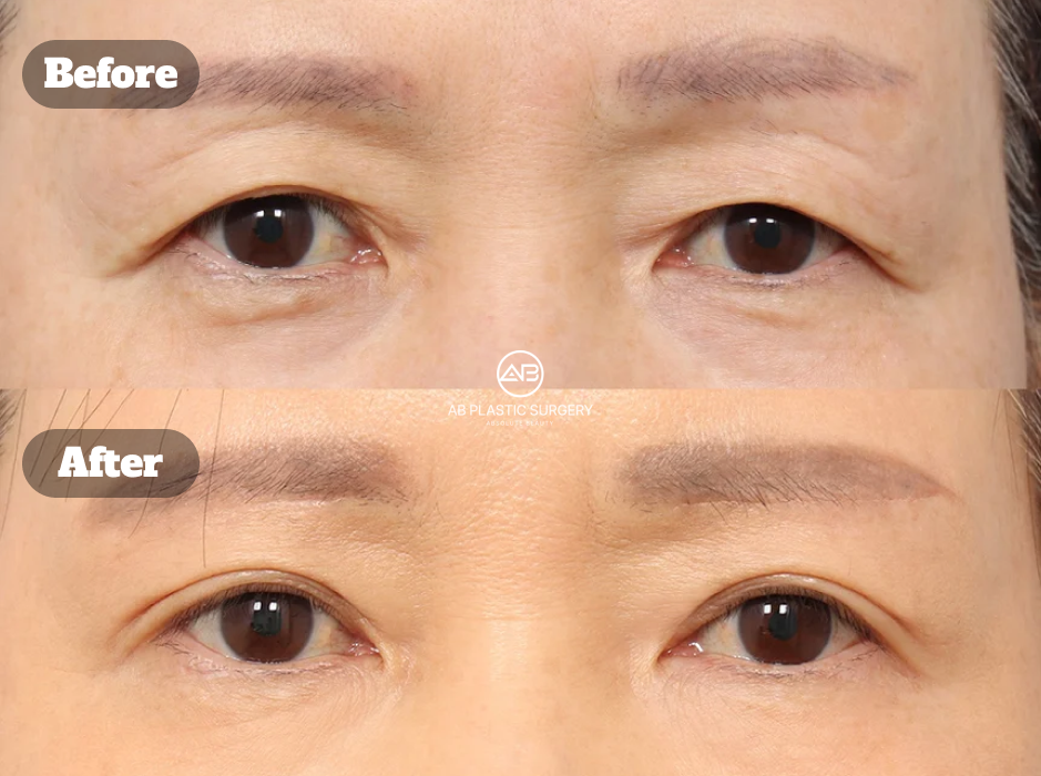 Before and After Ptosis Correction With Upper Eyelid Lifting and Brow Lift Improving Balanced Eye Position and Natural Lift Effect
