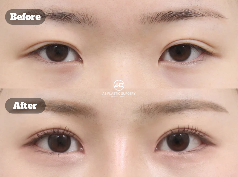 Before And After Results Of Korean Eye Plastic Surgery With Revision Incision Ptosis Correction Epicanthoplasty Lateral Canthoplasty And Lower Canthoplasty For Comprehensive Eye Shape Enhancement