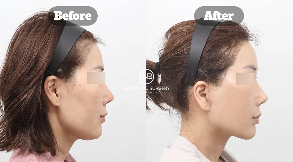 Before and After Neck Lifting for Double Chin Showing Refined Jawline and Smoother Side Profile in Korea