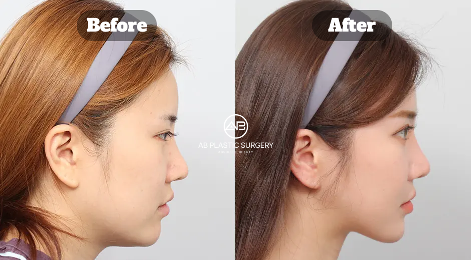 Before and After Three Facial Contouring Surgeries in Korea Including Square Jaw Cheekbone Reduction Chin Tip Surgery and Fat Grafting 9 Months Side Profile Results