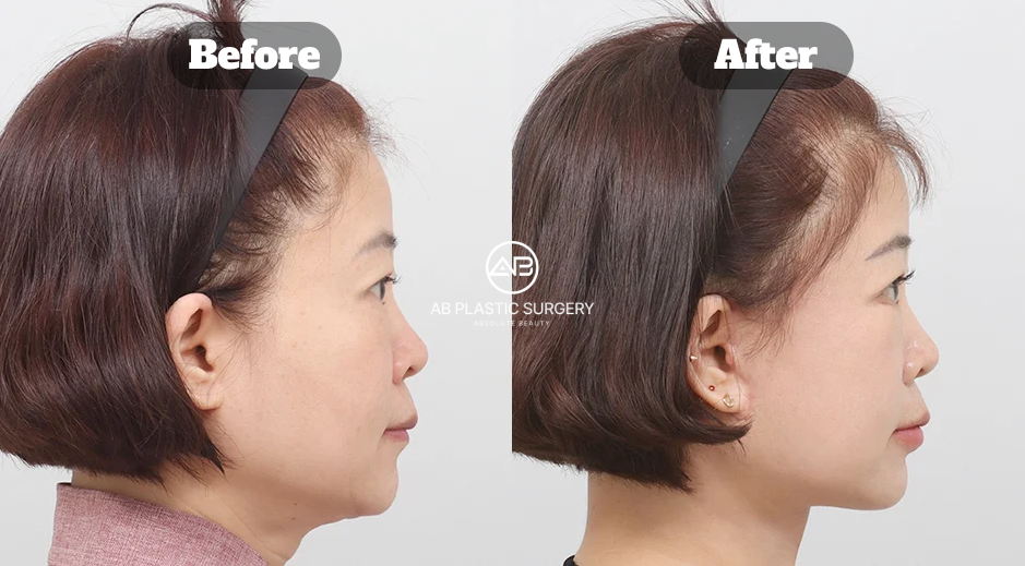 Before and After Neck Lifting for Double Chin Showing Soft Jawline Refinement and Natural Facial Contour Improvement in Korea