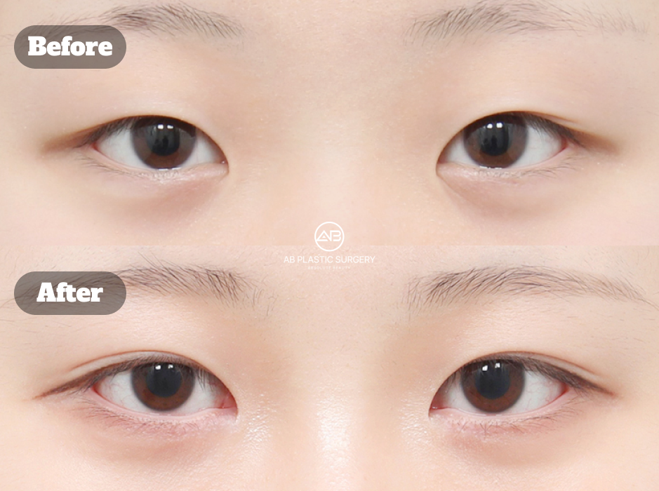 Before and After Buried Double Eyelid Surgery Combined with Epicanthoplasty and Eyelid Fat Removal at Korean Plastic Surgery Clinic Showing Clearer and Smoother Eye Contour