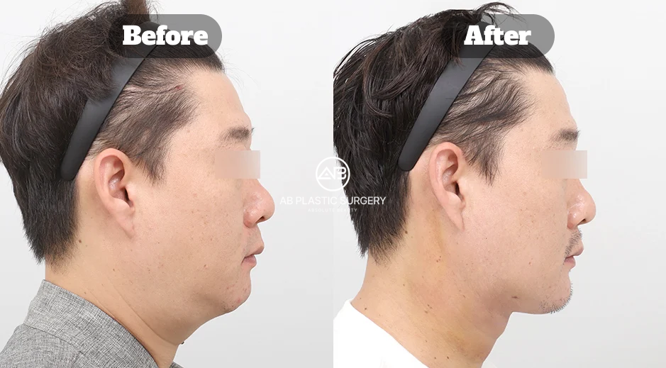 Before and After Double Chin Treatment Combining Thread Lifting Neck Lift and Liposuction for Sharper Jawline Contour in Korea