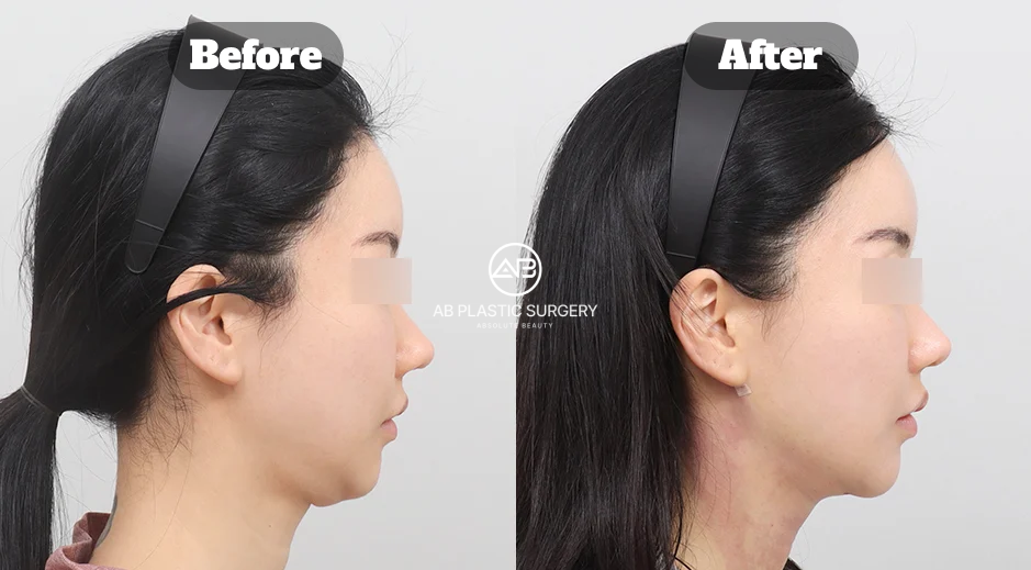 Before and After Elasticum Neck Lifting with Double Chin Muscle Tightening Showing Firmer Jawline and Lifted Neck Contour in Korea