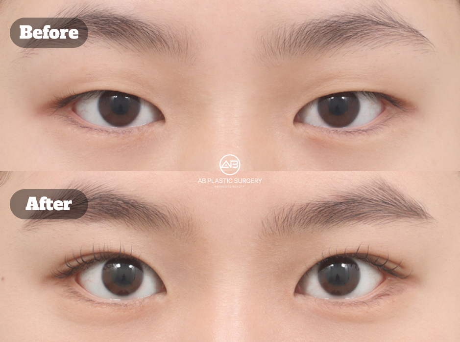 Before and After Non Incision Ptosis Correction at Korean Plastic Surgery Clinic Showing Improved Eye Opening and More Refreshed Eye Appearance