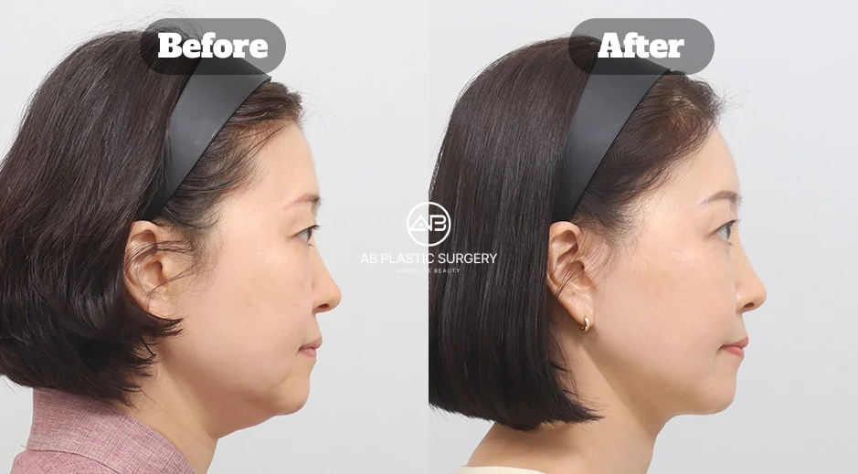 Before and After Double Chin Muscle Tightening with Neck Lifting Showing Improved Jawline Balance and Smoother Neck Line in Korea