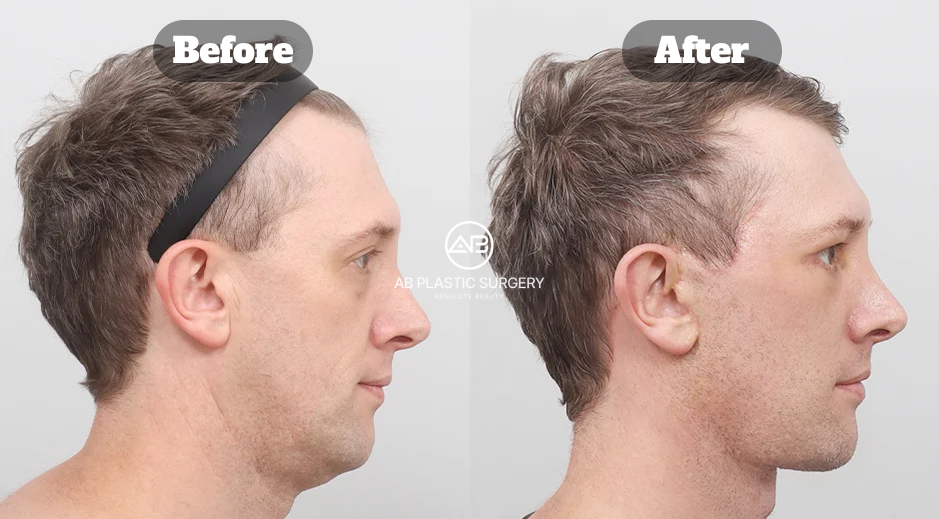 Before and After Full SMAS Neck Lifting with Double Chin Muscle Tightening and Fat Grafting Showing Restored Jawline Structure in Korea