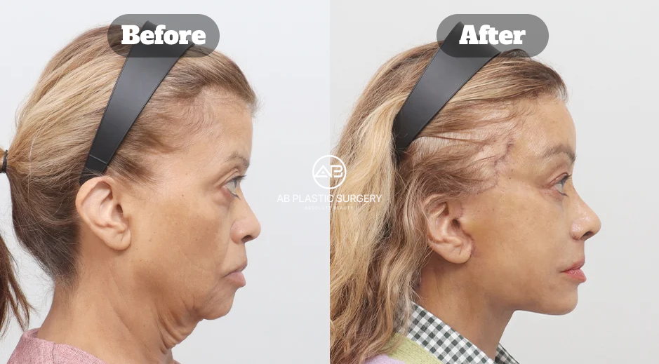 Before and After Full SMAS Neck Lifting with Double Chin Muscle Tightening and Facial Fat Grafting Showing Advanced Jawline Rejuvenation in Korea