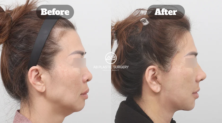 Before and After Full SMAS Neck Lifting with Double Chin Muscle Tightening Showing Lifted Jawline and Improved Neck Definition in Korea
