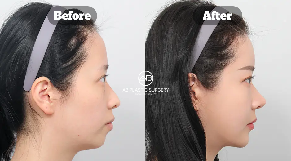 Before and After Facial Contouring Surgery in Korea Including Square Jaw Reduction Cheekbone Reduction Chin Tip Surgery and Fat Grafting 8 Months Results