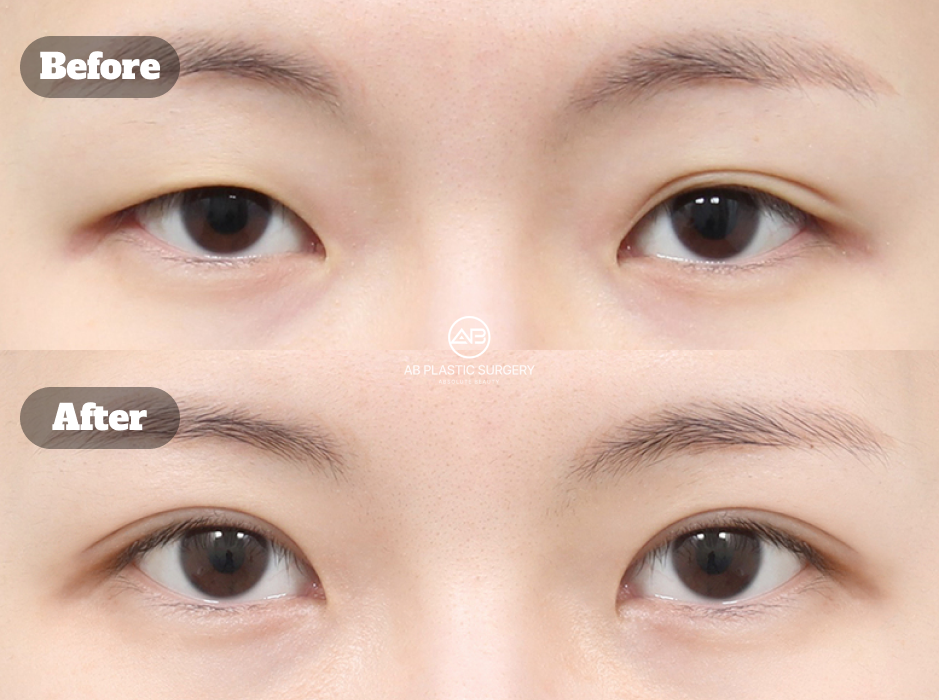 Before and After Incision Double Eyelid Revision Surgery at Korean Plastic Surgery Clinic Showing Improved Eye Symmetry and Crease Definition
