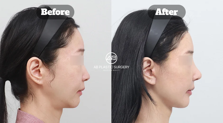 Before and After Double Chin Reduction with Neck Lift and Facial Liposuction for Sharper Jawline in Korea
