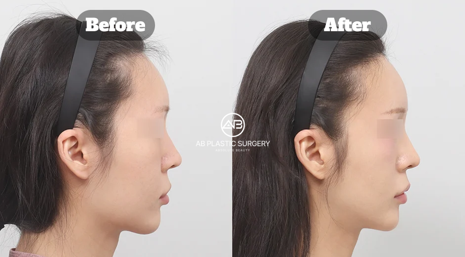 Before and After Square Jaw Reduction and Chin Tip Surgery in Korea Showing Facial Contour Improvement