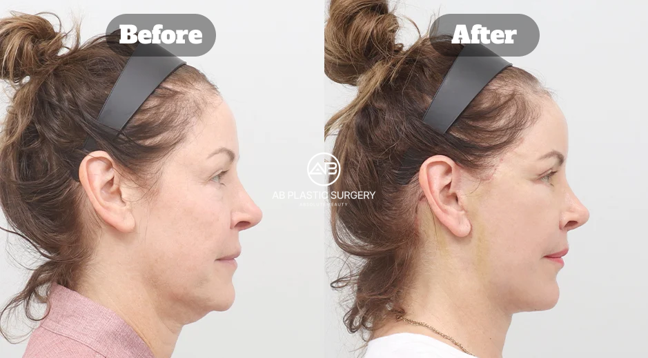 Before and After Neck Lifting for Double Chin Correction Showing Natural Jawline and Side Profile Improvement in Korea