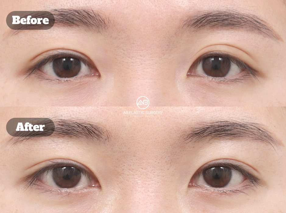 Before and After Non Incision Ptosis Correction Revision at Korean Plastic Surgery Clinic Showing Improved Eye Opening and Natural Eyelid Contour