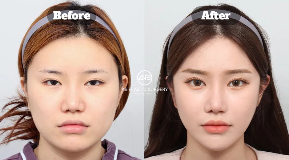 Before and After Three Facial Contouring Surgeries in Korea Including Square Jaw Cheekbone Reduction Chin Tip Surgery and Fat Grafting 9 Months Outcome