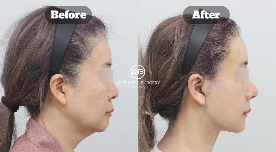Before and After Neck Lifting with Double Chin Muscle Tightening and Jawline Liposuction for Defined Facial Contour in Korea
