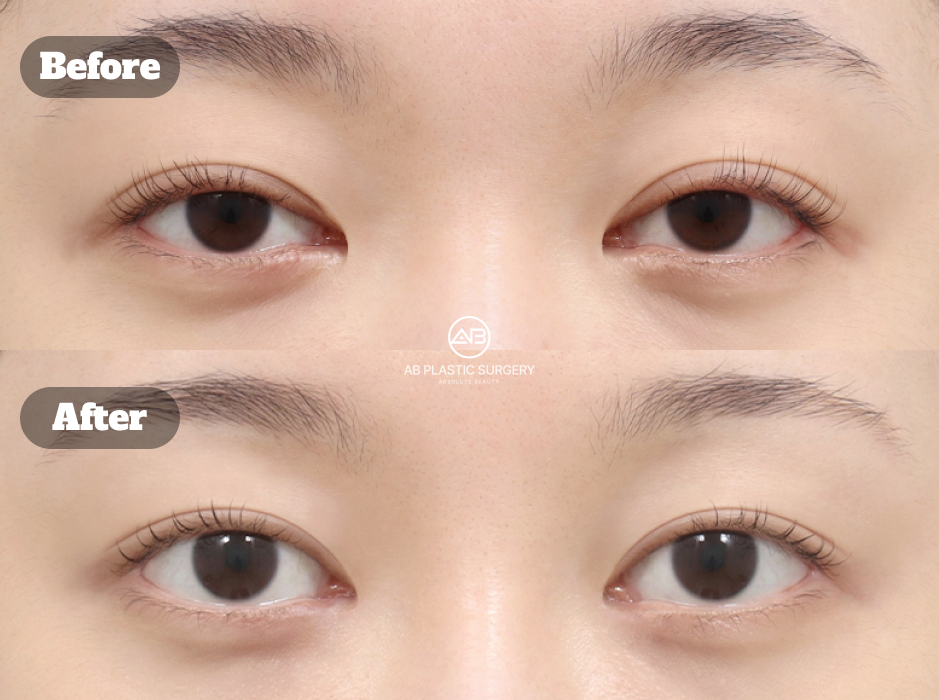 Before and After Incision Ptosis Correction with Epicanthoplasty Revision at Korean Plastic Surgery Clinic Showing Clearer Eye Shape and Improved Symmetry