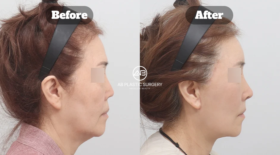 Before and After Neck Lifting for Double Chin Muscle Correction Showing Improved Jawline Definition and Facial Balance in Korea