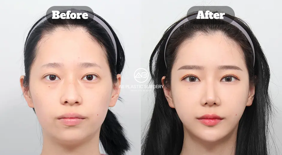 Before and After Full Facial Contouring Surgery in Korea Including Square Jaw Cheekbone Reduction Chin Tip and Fat Grafting 8 Months Outcome