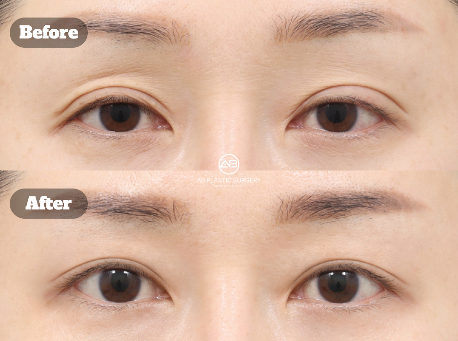 Before and After Incision Ptosis Revision Surgery at Korean Plastic Surgery Clinic Showing Enhanced Eyelid Opening and Smoother Eye Contour