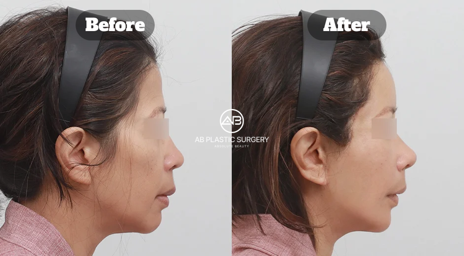 Before and After Neck Lifting with Double Chin Muscle Tightening Showing Slimmer Jawline and Improved Neck Contour in Korea