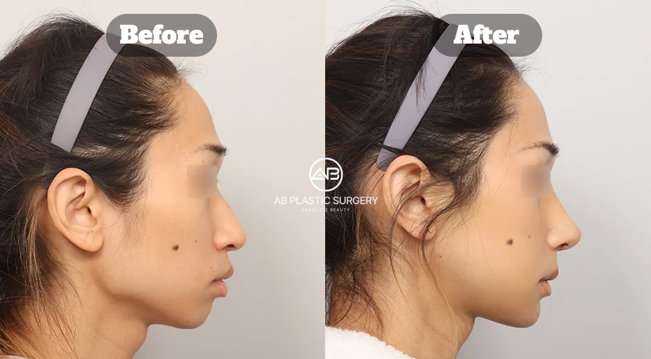 Before and After Facial Contouring Surgery in Korea with Square Jaw Reduction Cheekbone Contouring and Chin Tip Surgery Side Profile Result