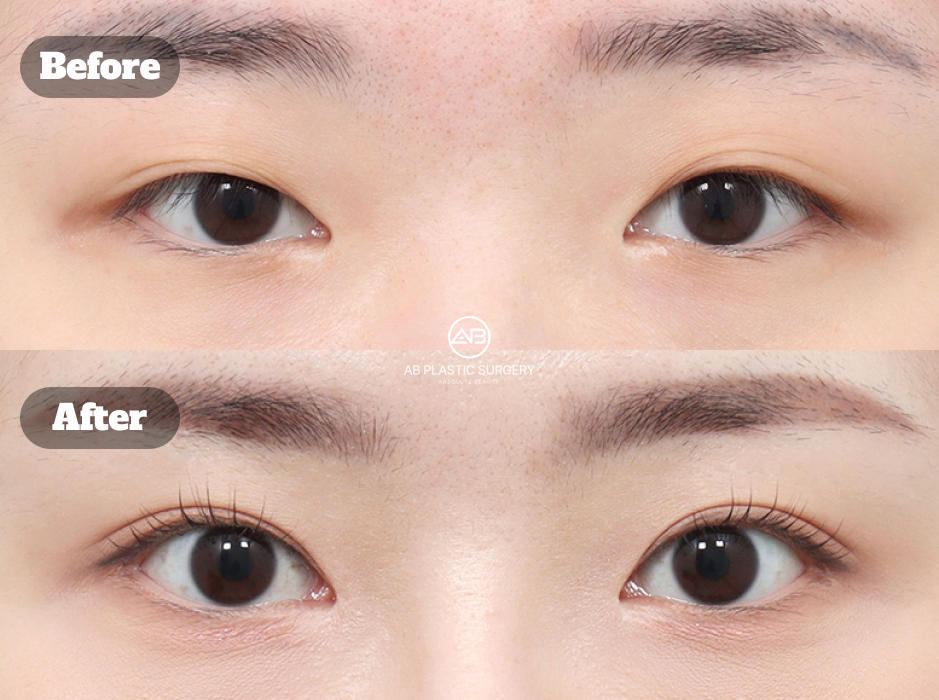 Before and After Eyelid Revision Surgery at Korean Plastic Surgery Clinic Showing Brighter Eyes and More Defined Eyelid Crease
