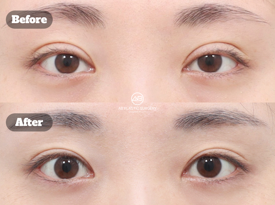 Before and After Double Eyelid Revision Surgery at Korean Plastic Surgery Clinic Showing Smoother Crease Line and Balanced Eye Appearance