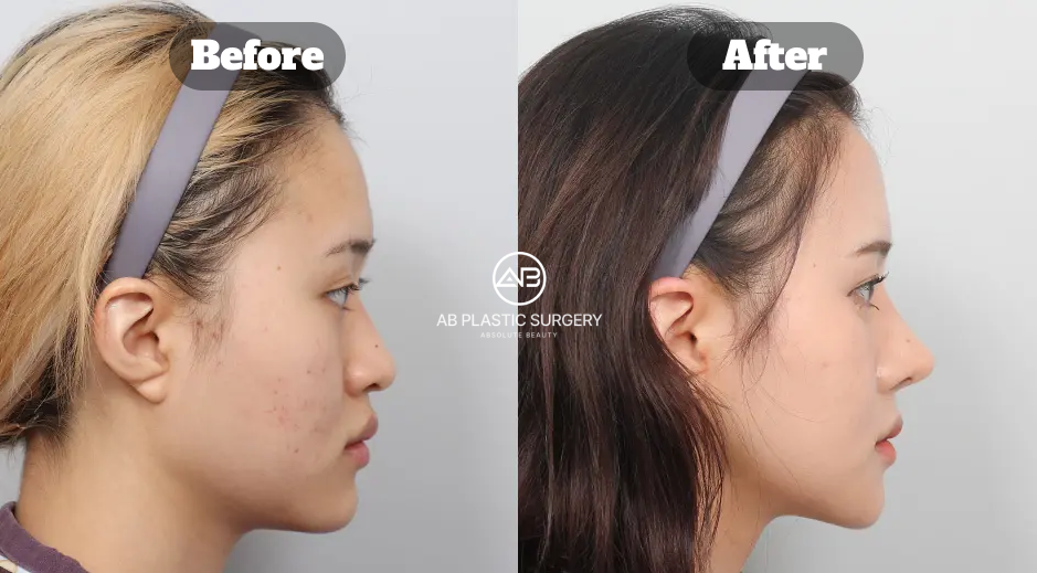 Before and After Facial Contouring Surgery in Korea Including Square Jaw Cheekbone Reduction Chin Tip and Fat Grafting 4 Months Side Profile Results