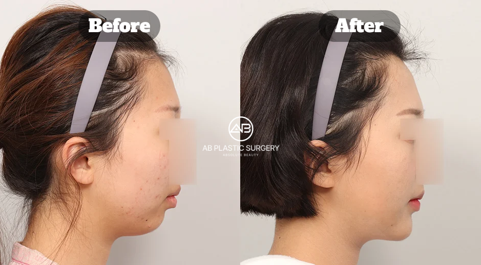Before and After Chin Augmentation Surgery in Korea for Recessed Chin Showing Improved Jawline and Facial Balance