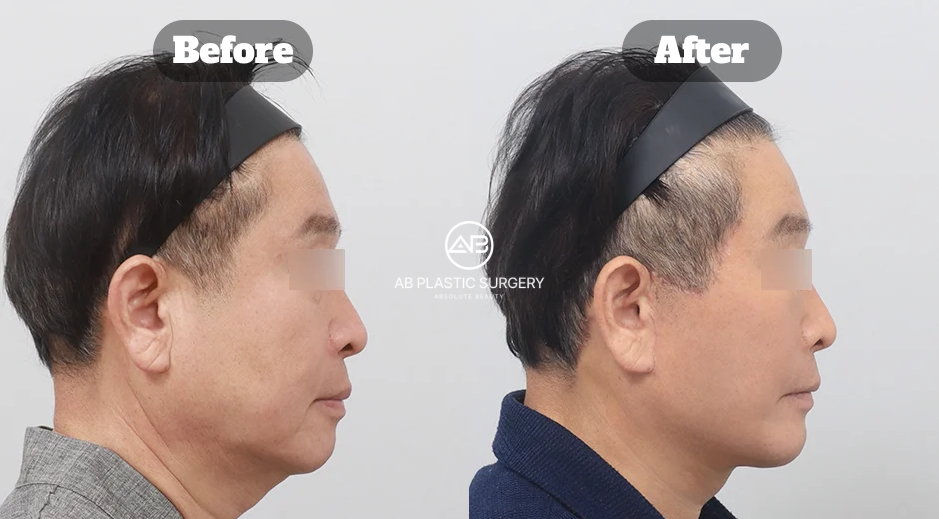 Before and After Double Chin and Neck Lifting Showing Jawline Rejuvenation and Firmer Neck Contour in Korea