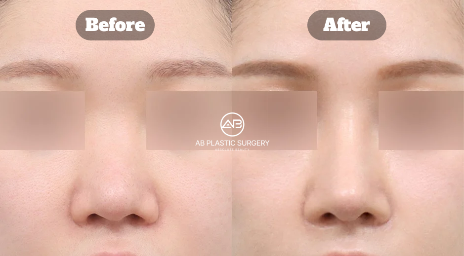 Before and After Results of Revision Rhinoplasty at AB Plastic Surgery Korea Correcting a Short Nose and Crooked Hump Deformity