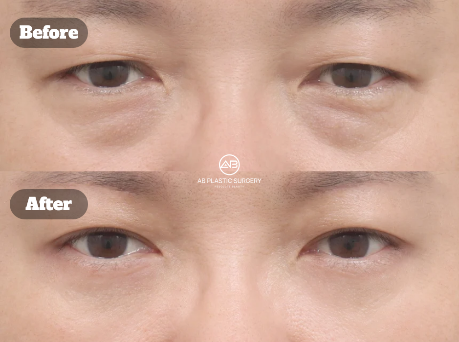 Lower Blepharoplasty Before and After Results at AB Plastic Surgery Korea
