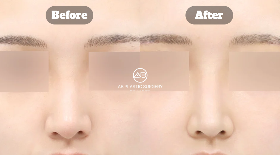 Before and After Results of Revision Rhinoplasty at AB Plastic Surgery Korea Using Implant-Free Hump Nose Correction
