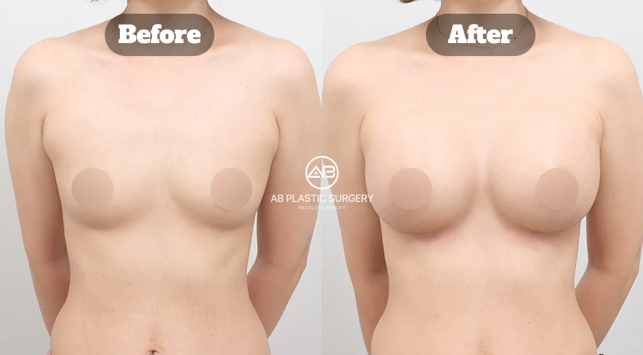 AB Plastic Surgery Korea Breast Augmentation Surgery Review and Results