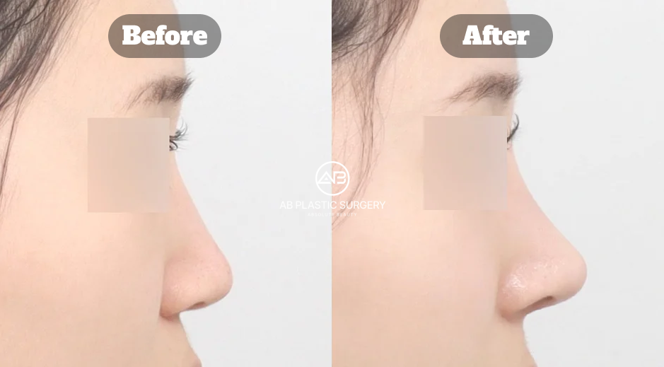 Before and After Results of Revision Rhinoplasty at AB Plastic Surgery Korea for Functional and Structural Nose Correction