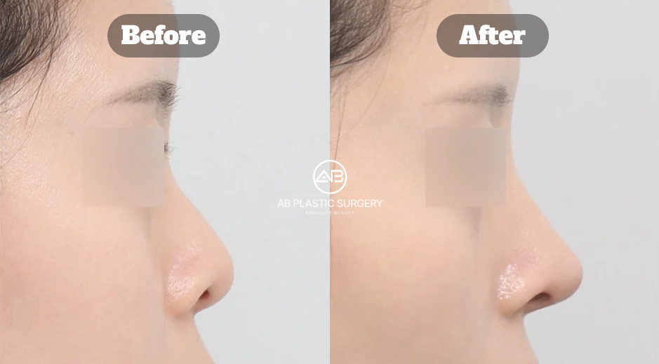 Before and After Results of Revision Rhinoplasty at AB Plastic Surgery Korea for Bulbous Nose and Functional Septal Repair