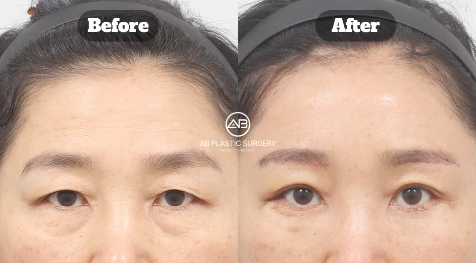 AB Plastic Surgery Korea Endotine Brow Lift and Eye Rejuvenation Results
